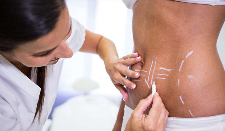 Lipo lad: entenda a diferença em relação à Lipoaspiração tradicional