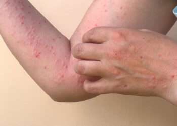 Prefeitura de Parauapebas esclarece que o município não tem nenhum caso suspeito de Mpox